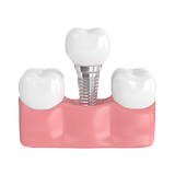 Animated implant supported dental crown icon