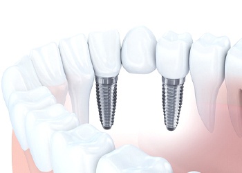 Implant-retained bridge