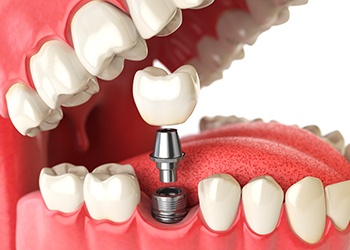 Animation of implant supported dental crown