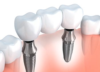 Animation of implant supported bridge