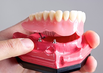 Model of implant supported denture