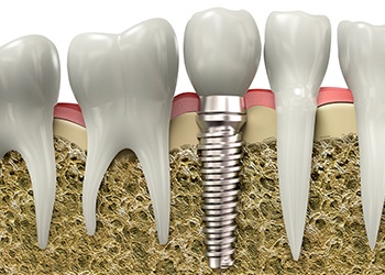 Animation of supportive tissue below gum line with implant