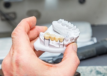 Model of smile with traditional bridge