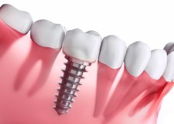 single dental implant