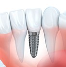 Animation of implant supported dental crown