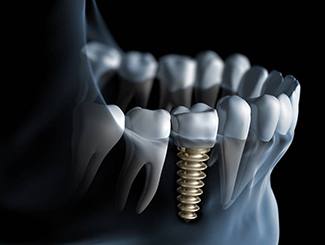 Illustration of implant supported crown