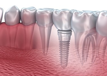 Animation of implant supported dental crown