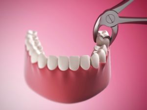 model of tooth extraction